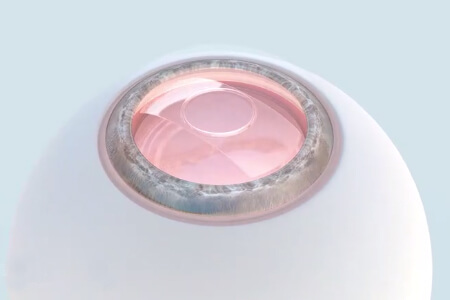 依鏡PRL晶體植入術(shù)注意事項，尤其第二步！