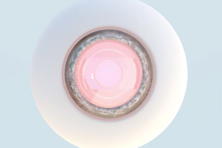 【史上最全】一文介紹清楚ICL和依鏡PRL的區(qū)別 【史上最全】一文介紹清楚ICL和依鏡PRL的區(qū)別